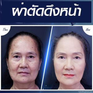 ผ่าตัดดึงหน้า-ศัลยกรรมดึงหน้า